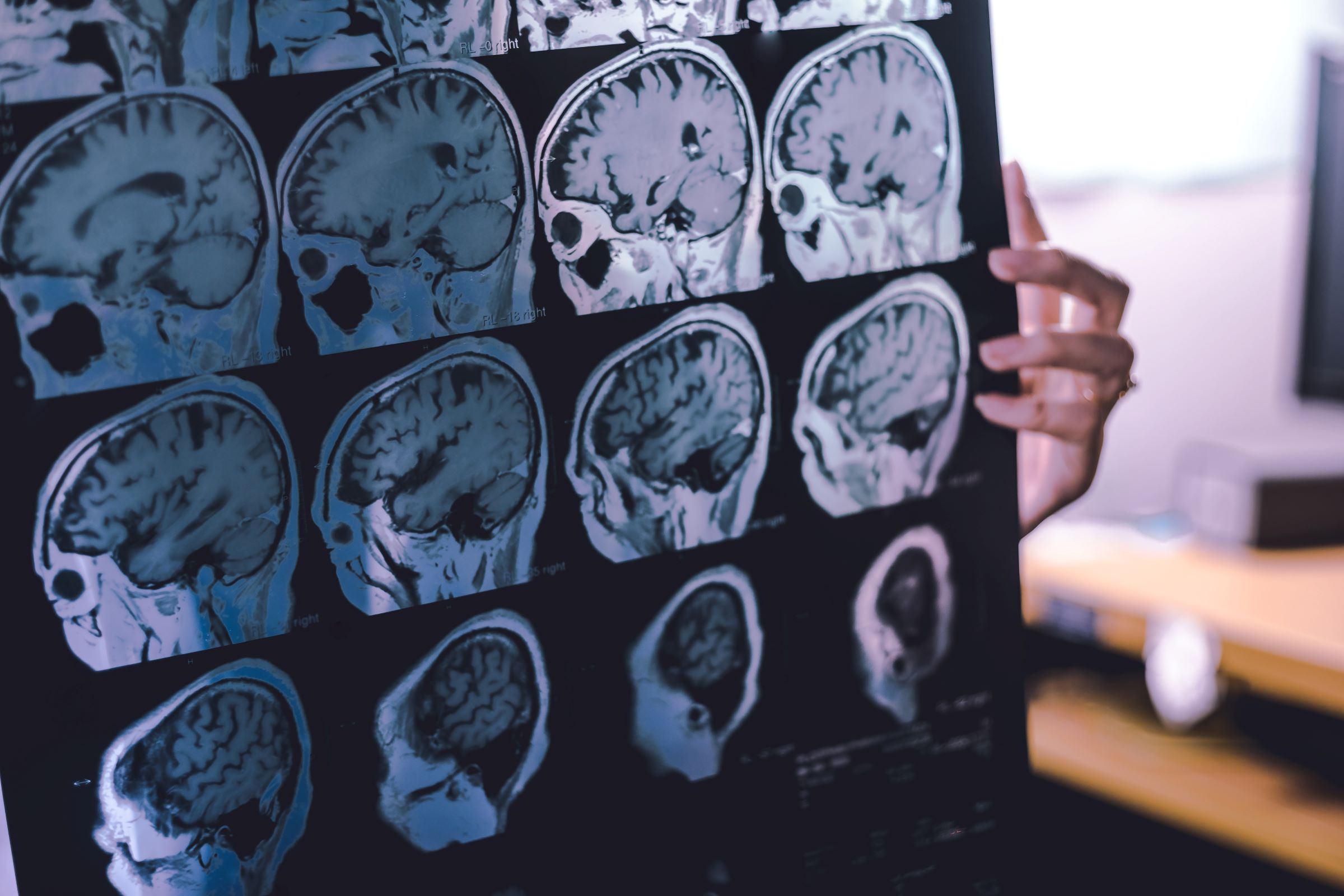 MRI film showing atrophy from frontotemporal dementia (F T D).